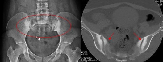 说说骶髂关节的那些事下腰痛的另外一些原因