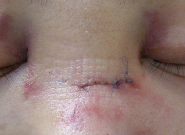 外伤后如何减小瘢痕