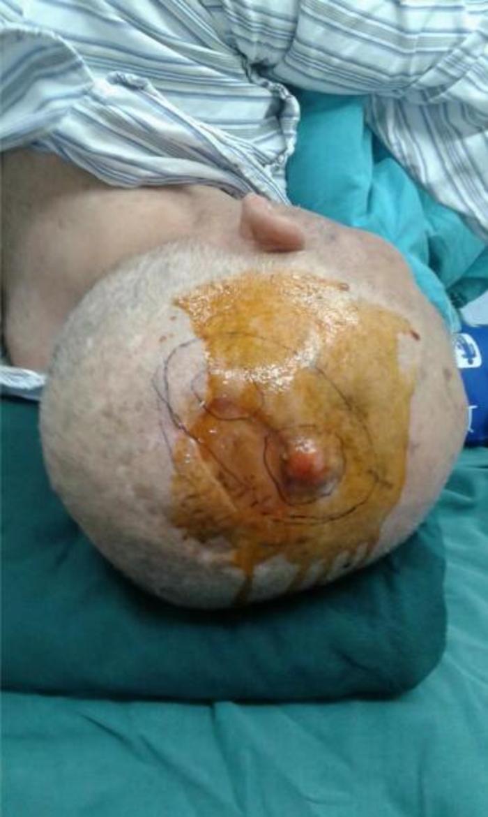 头皮鳞状细胞癌术后复发