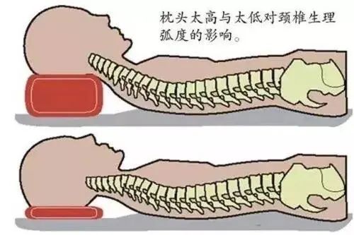 时间久了就会导致颈椎生理曲度减少,变直甚至反弓.