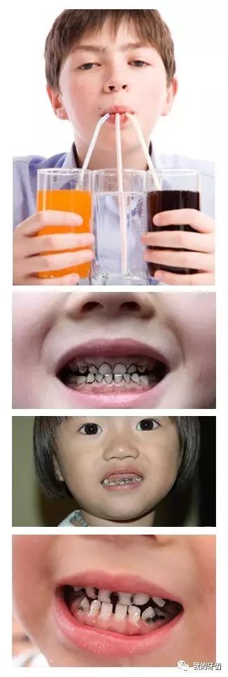 碳酸饮料对牙齿图片