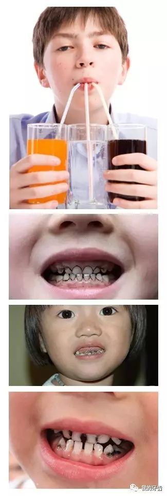 儿牙科普碳酸饮料是如何慢慢地腐蚀你的牙齿