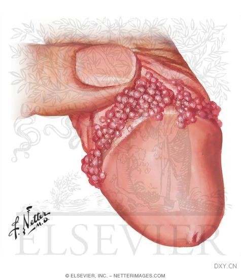 他得了"菜花"吗?