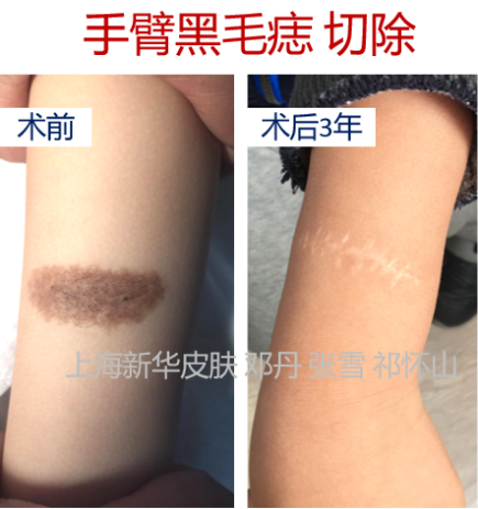 病例系列06几例手臂黑毛痣的治疗