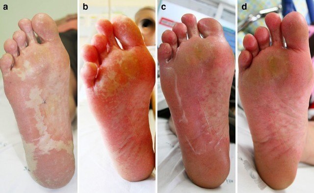 肿瘤药物治疗手足皮肤反应的研究进展及处理