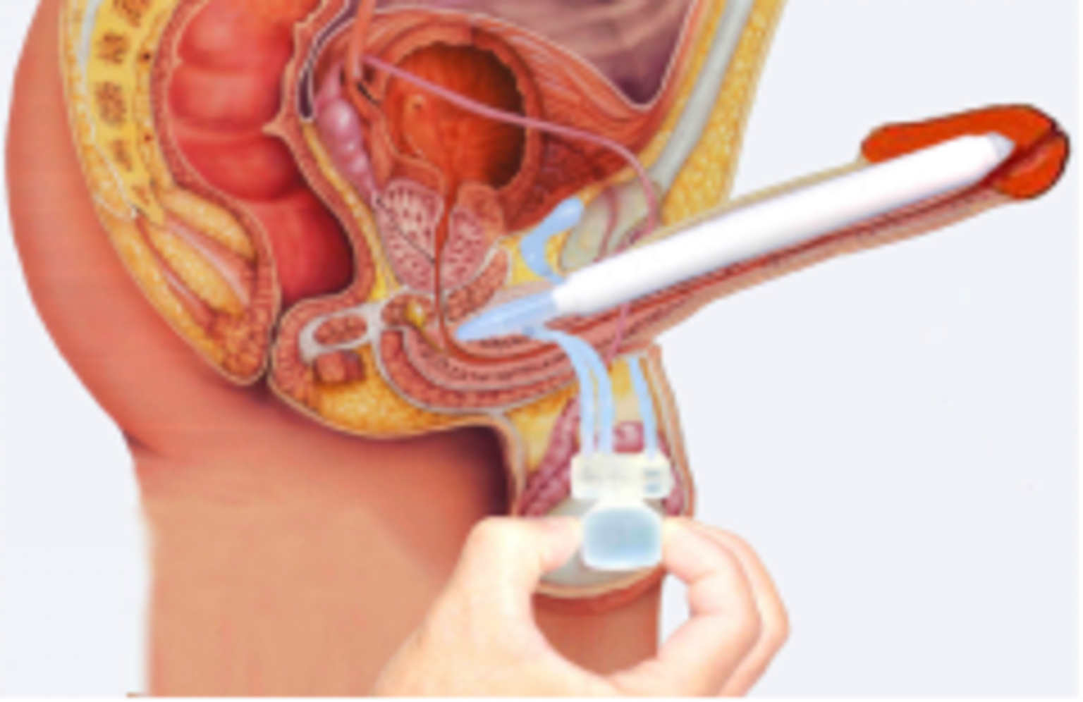 全面了解阴茎支撑体假体手术之三使用方法和注意事项