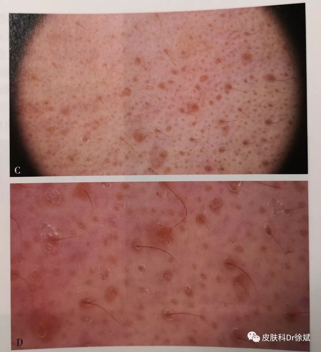 262丨识别早期白癜风的潜望镜偏振光皮肤镜