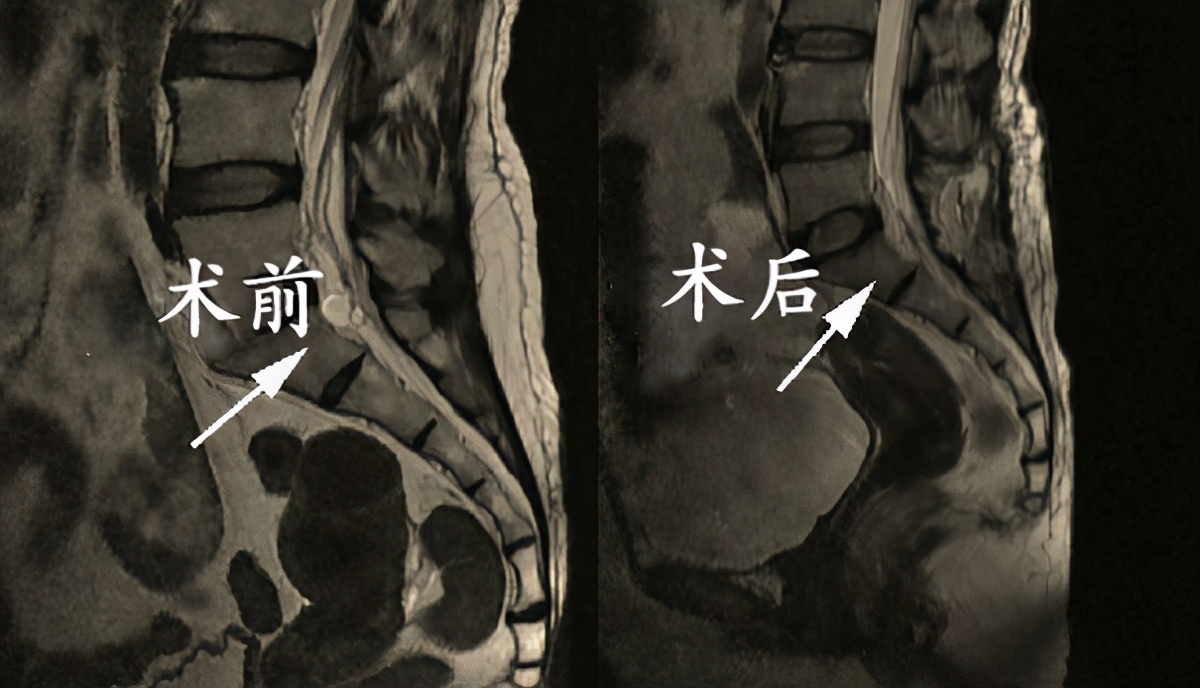 如果查出骶管囊肿了怎么办别慌只有两种情况才需要处理