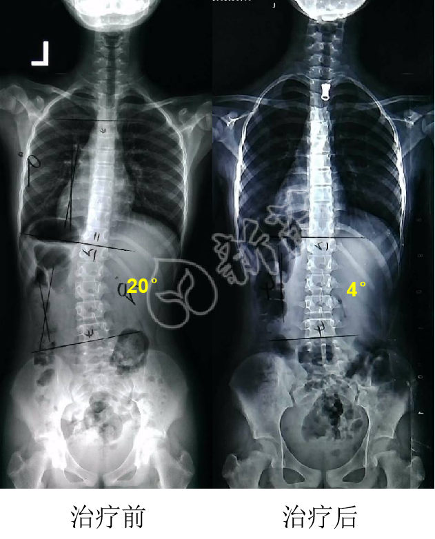 我是怎么从脊柱侧弯20度减到4度的