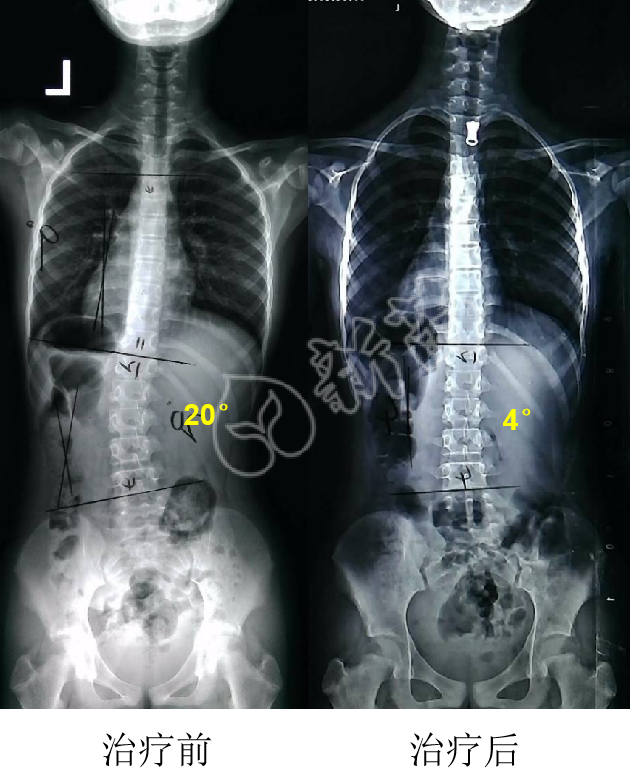 脊柱侧弯180度图片图片
