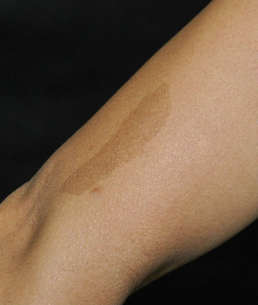 宝宝的牛奶咖啡斑,是"记"还是"疾"? - 微医(挂号网)