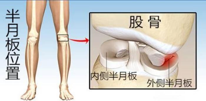 半月板是什么?不要认为膝盖疼就是关节