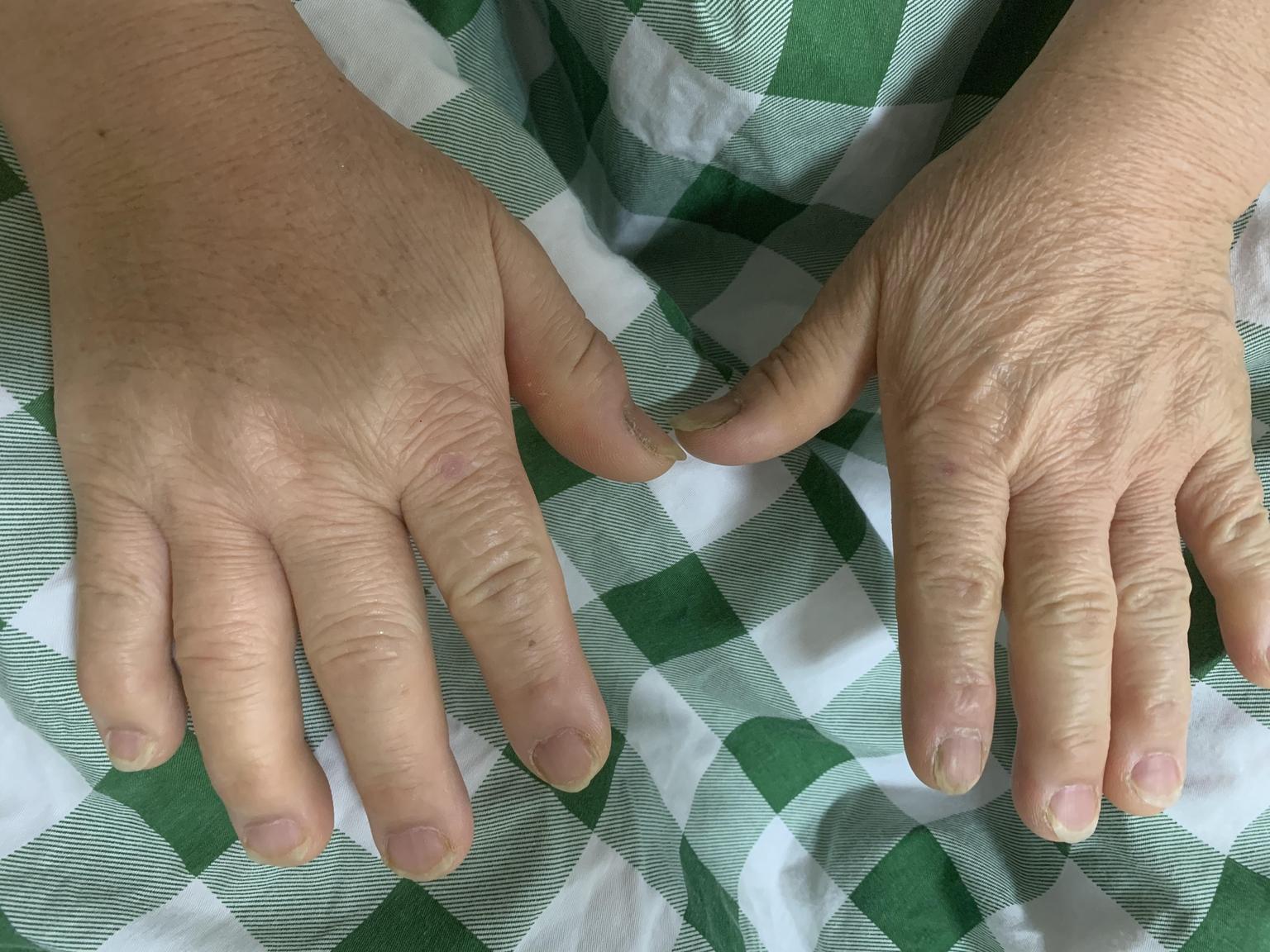 长得越来越丑原来是脑垂体瘤在作怪