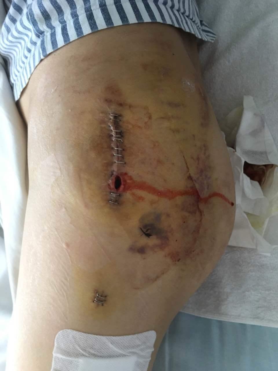 手术后如何进行伤口换药 - 微医(挂号网)