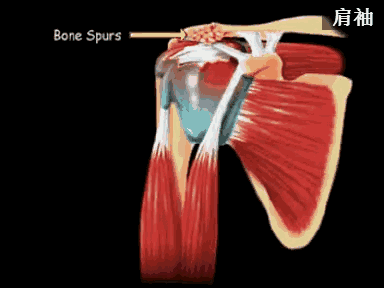 从解剖结构和承受的机械应力来看,该部位为肩袖的薄弱点,当肩关节在外