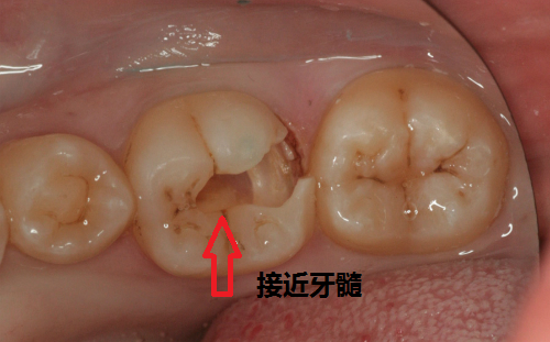 我不随意做根管治疗