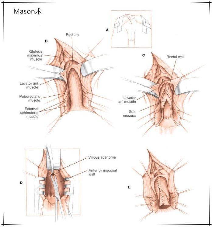 吻合器吻合fain是首位在英语国家介绍吻合器的专家(1975).