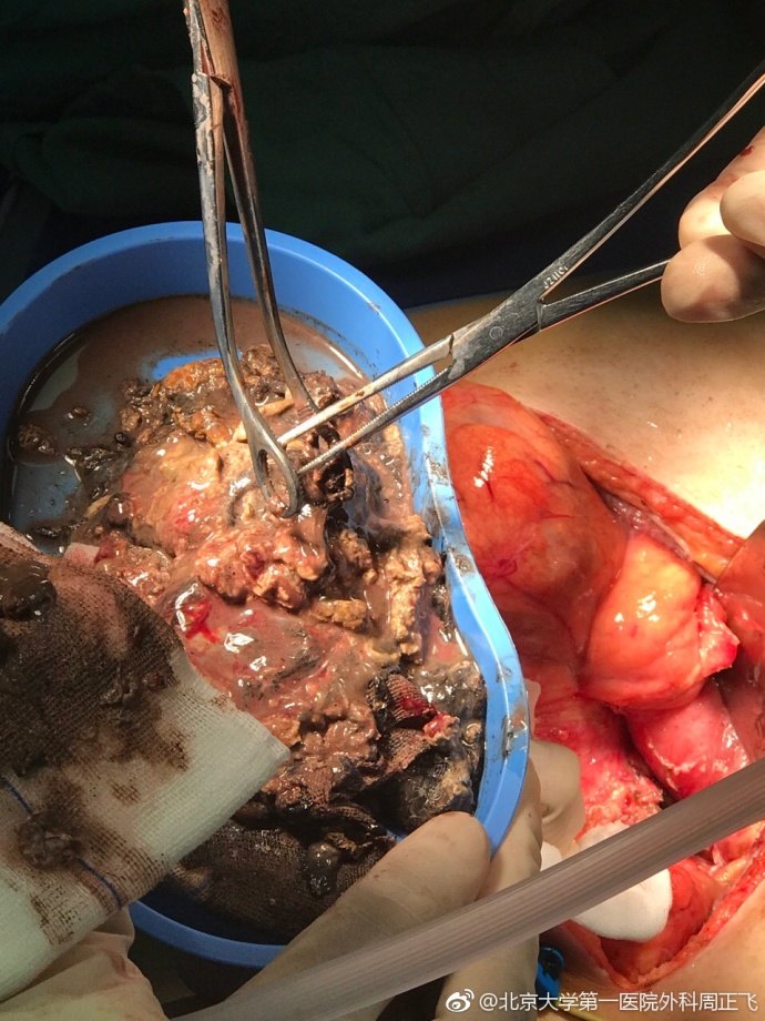 急性重症胰腺炎感染坏死性胰腺炎胰腺脓肿的手术救治