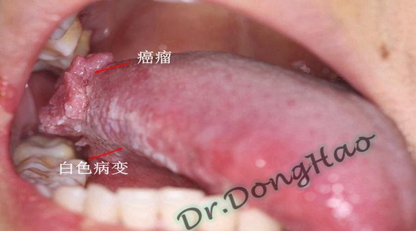 口腔黏膜上有白色斑块 小心变成癌 健康号 微医