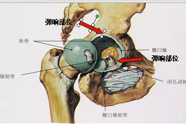 髋关节弹响的原因