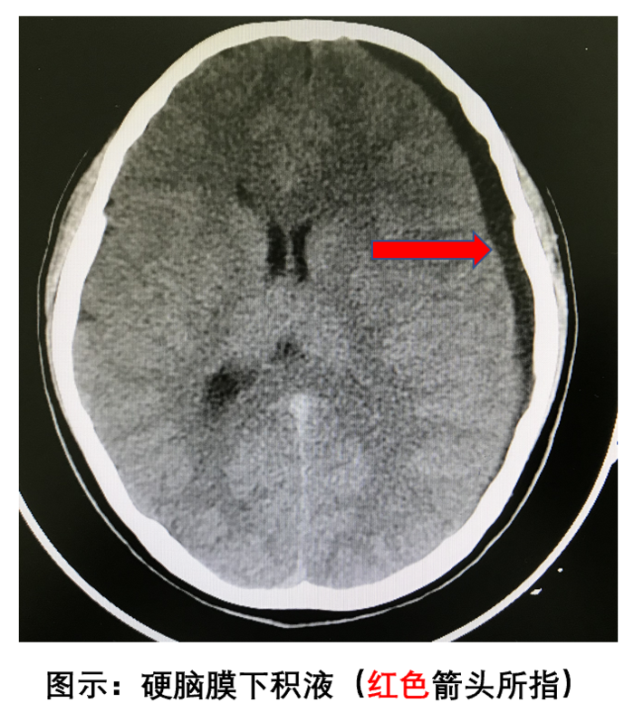 民医生说为什么会硬脑膜下积液