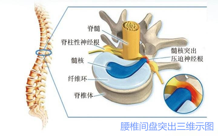腰椎间盘突出症的症状