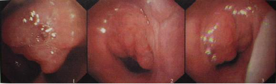 儿童鼾症腺样体肥大