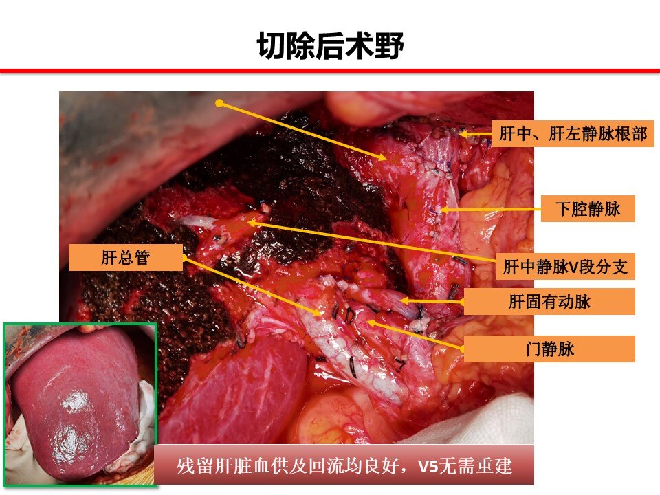 原發性肝癌轉化切除病例連載4累及肝門的肝內膽管癌的轉化切除