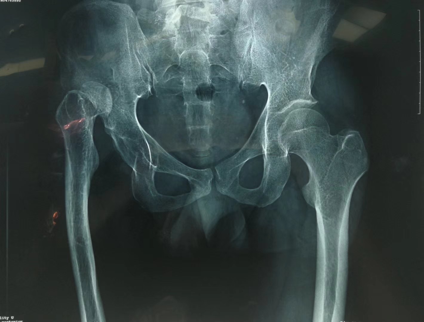 髋关节发育不良Ⅳ型高脱位截骨关节置换手术