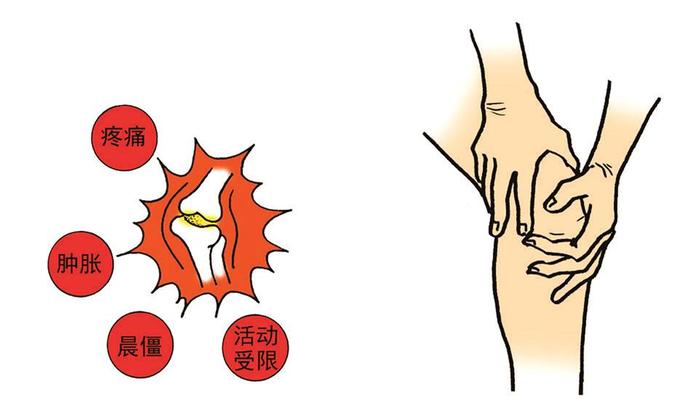 膝关节骨性关节炎的五个病因