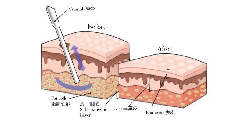 如何区分面部脂肪堆积与颊脂垫的问题
