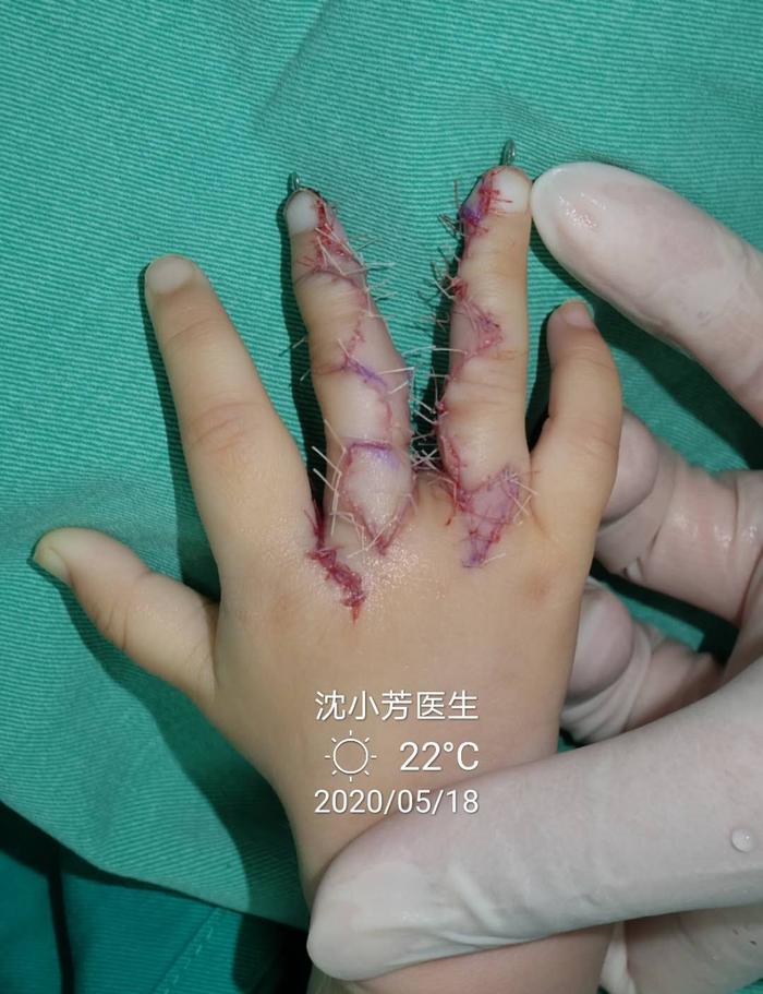 并指案例