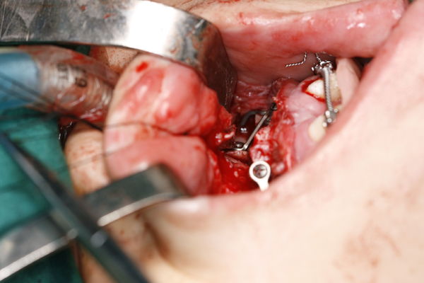 术后需要颌间牵引要求别太高,这已经不错了,这样手术难度低正常人难度