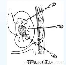 治疗肾结石的微创技术--经皮肾镜取石术(pcnl)