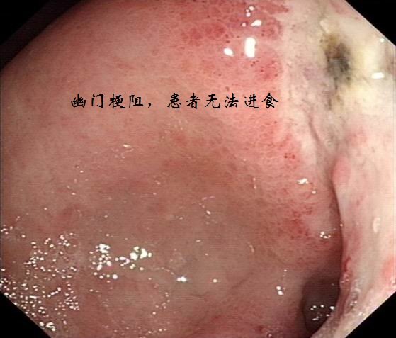 然而合并幽门梗阻的晚期胃癌患者却大多失去手术治疗机会.