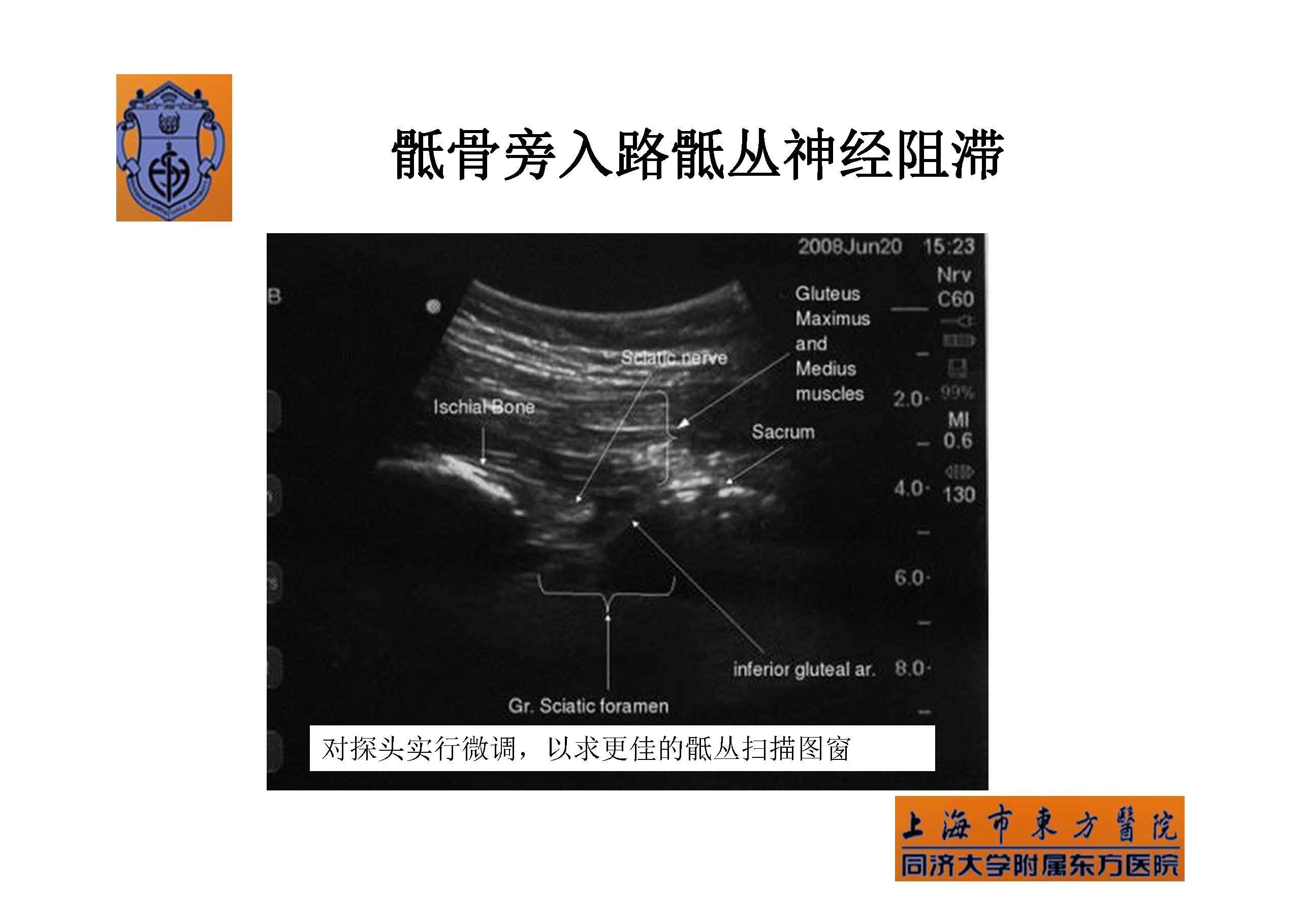 骶丛神经阻滞图片