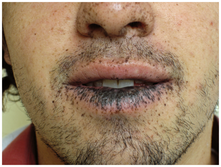 即肚子里面胃肠道中有息肉或者肿瘤,比如家族性黑斑息肉综合征(家族性