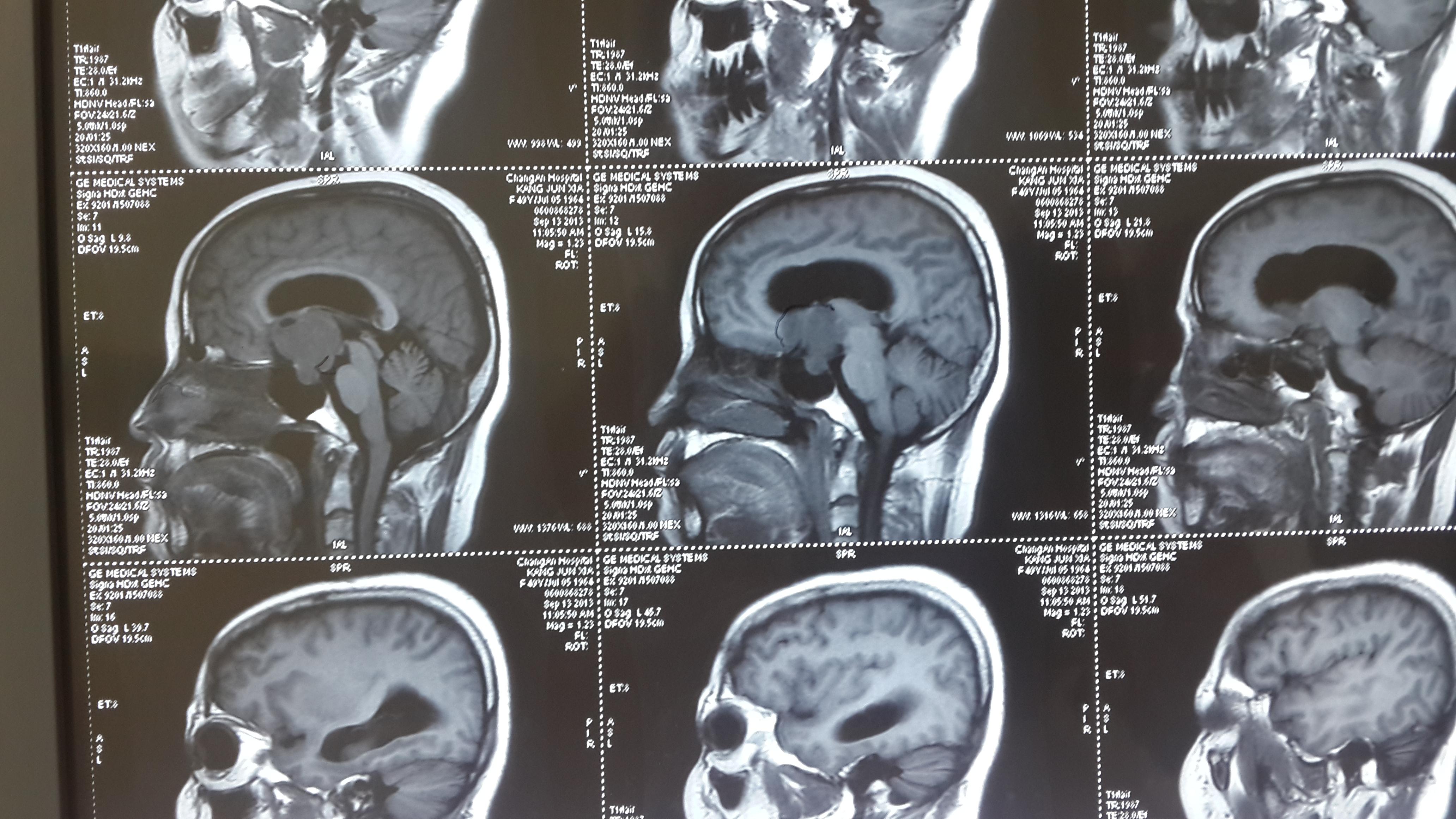 垂体腺瘤影像学表现及鉴别诊断 - 影像医学和核医学讨论版 -丁香园论坛