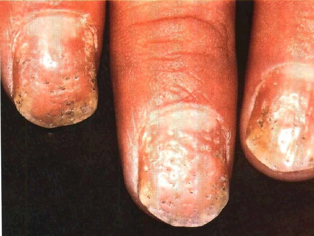 银屑病指甲太受伤很多被误诊