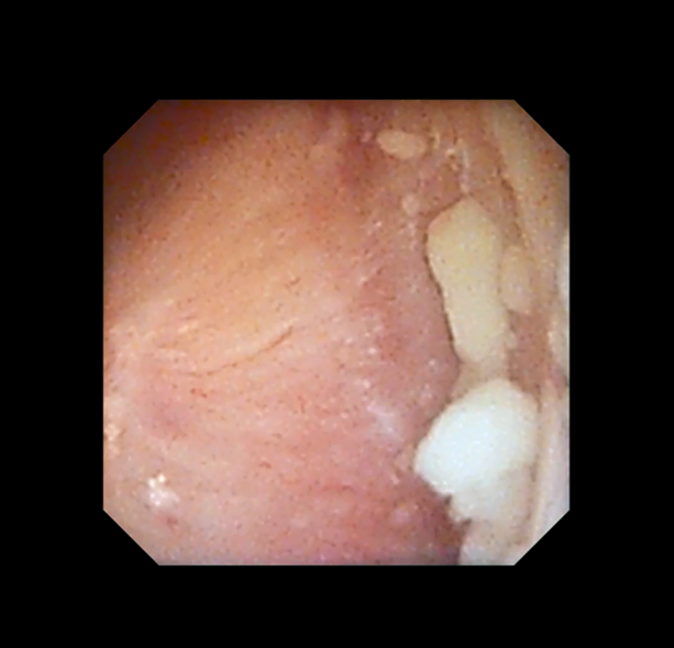 结石分析提示为硬度很高的一水草酸钙结石2018年06月手术患者,男性
