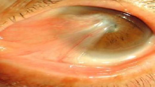 翼状胬肉经典问答