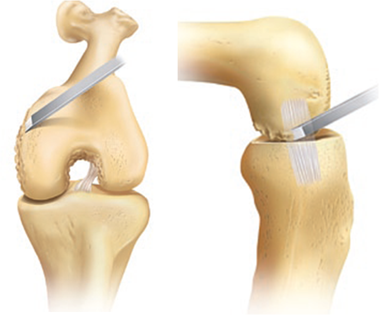 膝关节置换截骨步骤图图片