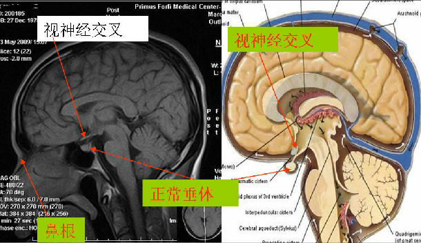 垂体瘤的诊断与治疗方法简介
