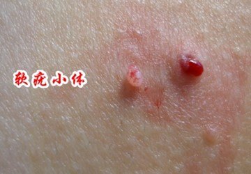 难言的外生殖器皮肤病之「传染性软疣」