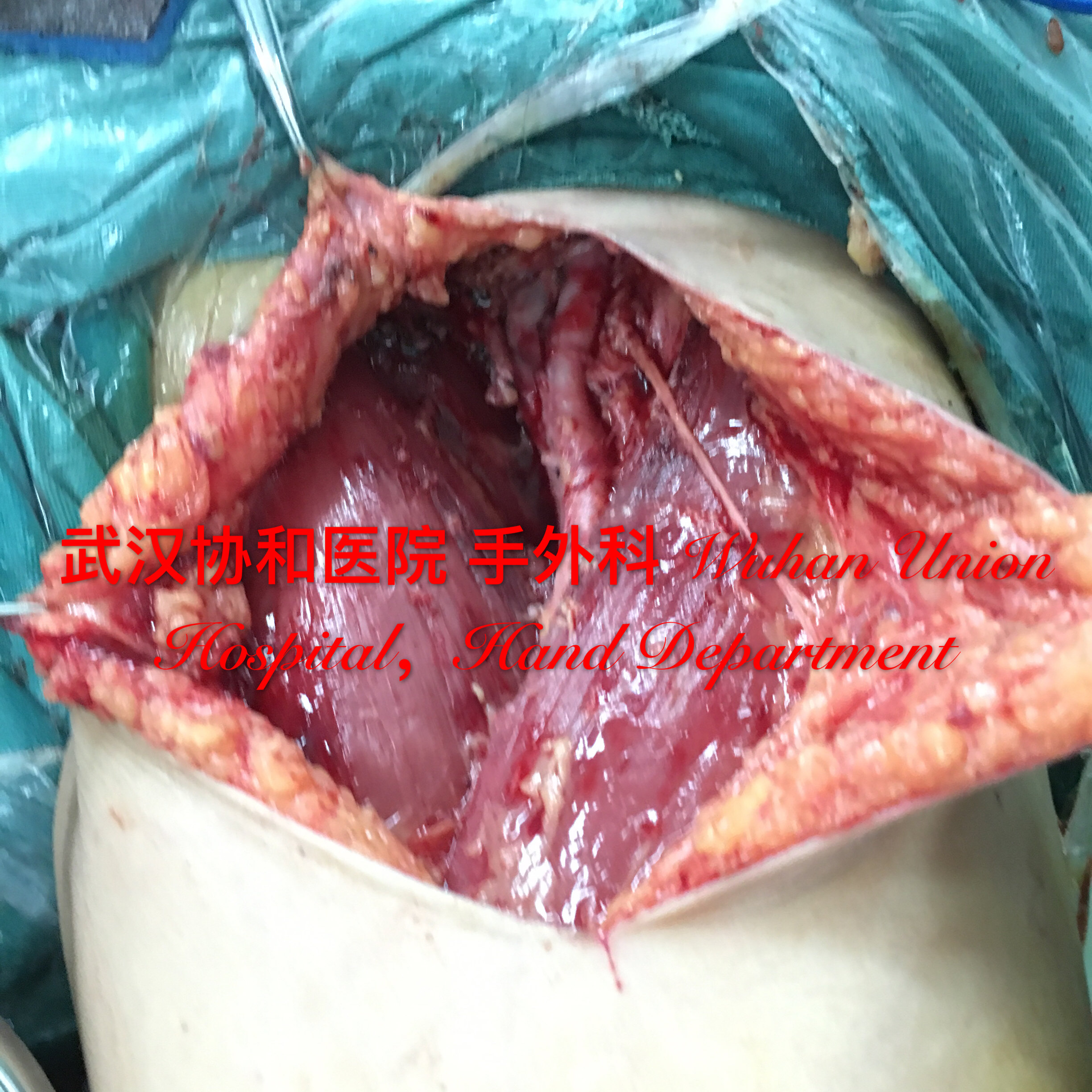 皮肤恶性黑色素瘤发生淋巴结转移后的伤口治疗