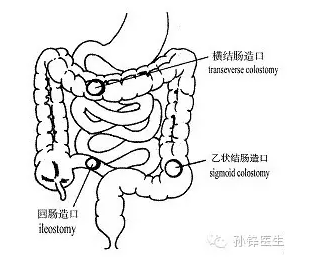 乙状结肠造口位置图片