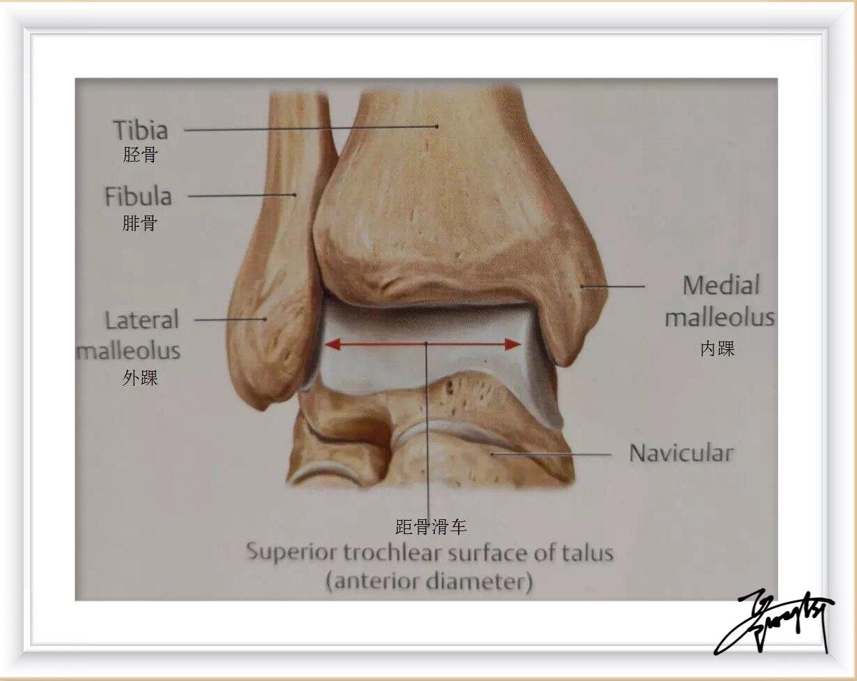 警惕反复崴脚也会导致踝关节距骨软骨损伤喔
