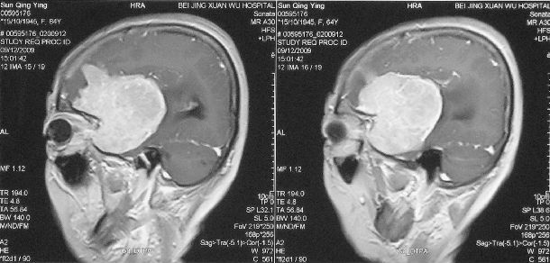 左侧蝶骨嵴巨大脑膜瘤切除根治