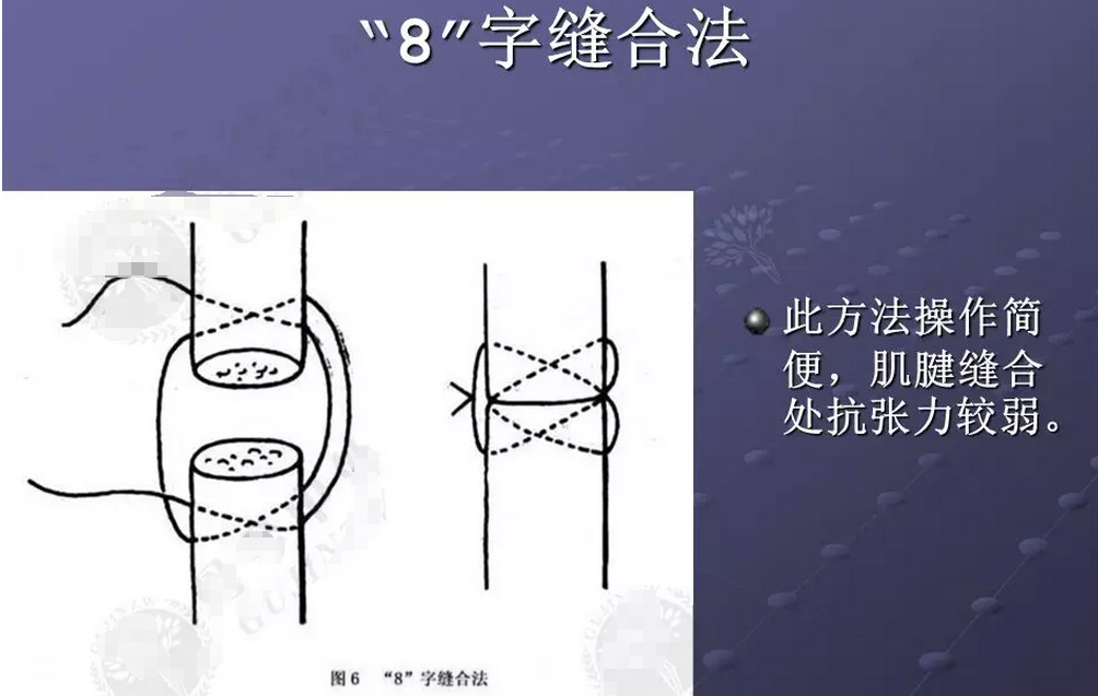 肌肉缝合方法图片