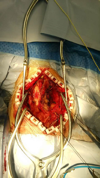 上海瑞金医院功能神经外科占世坤主任开展痉挛性斜颈微创外科治疗